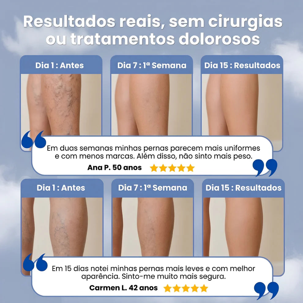 VariVeins™ - Volta a Ter Pernas Leves Neste Verão